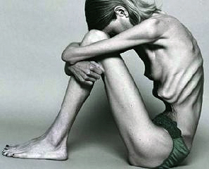 Dying to be Thin: Anorexic.
